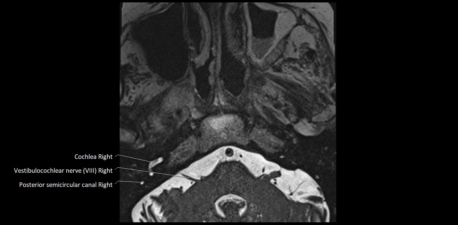 Cranial nerve anatomy axial MRI 3T image 61.webp
